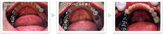 インプラント